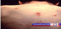 Шинэ цэргүүд улаанбурхан өвчнөөр өвчилжээ 