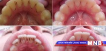 Лимоны шүүс, хүнсний содаар шүдээ цайруулж болно