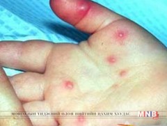 Гар, хөл, амны өвчнөөс сэргийлцгээе