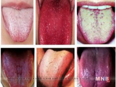 Амны хөндийн эрүүл мэндэд шүдний цоорлоос гадна хэлний ариун цэврийг сахих нь чухал