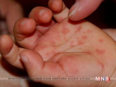 Гар, хөл, амны өвчин гэж юу вэ 