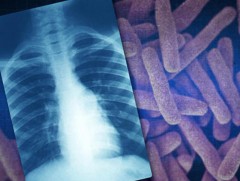 Иргэд сүреэгийн халдвартай эсэхээ үнэ төлбөргүй оношлуулж, эмчлүүлэх боломжтой