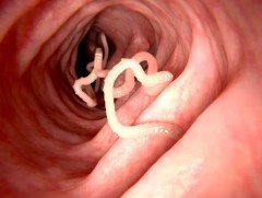 Хятад иргэний тархинаас туузан хорхой илэрчээ