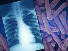 Хүүхдүүд ихэвчлэн томчуудаас сүрьеэгийн халдвар авдаг 