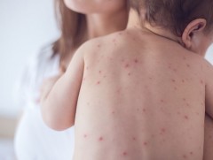 2018 онд улаан бурхан өвчний улмаас 140 мянга гаруй хүн амиа алджээ