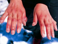 Осголт хөлдөлтийн үед үзүүлэх анхан шатны тусламж