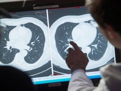 Ирэх 20 жилд дэлхий дахинд хавдрын өвчлөл 60 хувиар нэмэгдэнэ