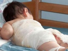 Бага насны хүүхдүүд цагаан идээ боловсруулдаг тогоонд унаж, түлэгдэж байна