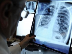 Коронавирусээр өвчилсний дараах нөхөн сэргээх эмчилгээг заавал хийлгэх шаардлагатай