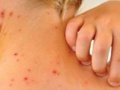 Бага насны хүүхдийн дунд менингококкт халдвар их бүртгэгдэж байна