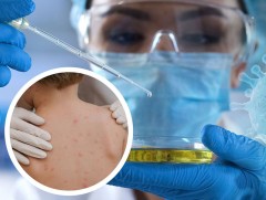 Латин Америкт сармагчны цэцэг өвчний 2 тохиолдол илэрчээ 