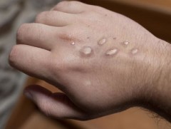 АНУ эмнэлгүүддээ сармагчны цэцэг өвчний 300 мянган тун вакцин хуваарилна