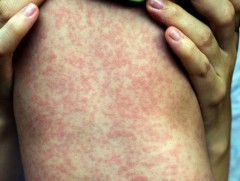 Улаанбурхан өвчин хүндэрвэл аюултай 