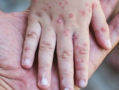 Улаанбурхан өвчний тохиолдол нэмэгдэх хандлагатай байна