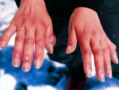 Осголт, хөлдөлтийн үед үзүүлэх анхан шатны тусламж