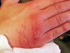 Гар, хөлийн ганц хуруу хөлдсөн ч эмнэлгийн тусламж авах хэрэгтэй