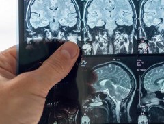 Эпилепси нь маш олон шалтгааны улмаас бий болдог 