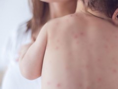 Улаанбурхан өвчний 85 дахь тохиолдол батлагдлаа