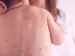 Улаанбурхан өвчний зургаа дахь тохиолдол 7 сартай хүүхдэд батлагдлаа