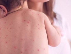 Улаанбурхан өвчний батлагдсан тохиолдол 125 болжээ