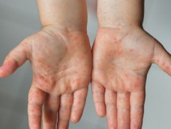 Улаанбурхан өвчний 11 дэх тохиолдол батлагдлаа