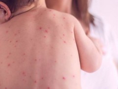 Улаанбурхан өвчний батлагдсан тохиолдол 93 болжээ