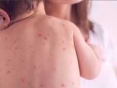 ХӨСҮТ: Улаанбурхан өвчний лабораториор батлагдсан тохиолдол 479 болжээ 