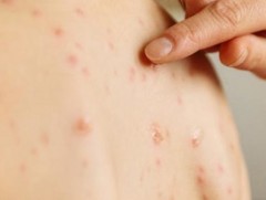 ХӨСҮТ: Улаанбурхан өвчний батлагдсан тохиолдол 1615 болжээ