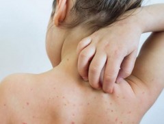 Дархан-Уул аймагт улаанбурхан өвчнөөр 10 хүүхэд, 3 том хүн хэвтэн эмчлүүлж байна