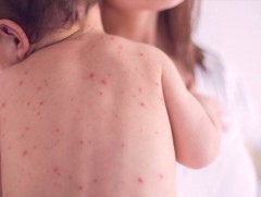 ХӨСҮТ: Улаанбурхан өвчний лабораториор батлагдсан тохиолдол 11179 болжээ