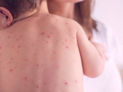 ХӨСҮТ: Улаанбурхан өвчний лабораториор батлагдсан тохиолдол 11338 болжээ