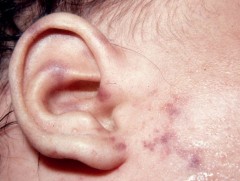 Менингококкт халдварын нэн хүнд үед 4-6 цагийн дотор цусархаг тууралт гарна