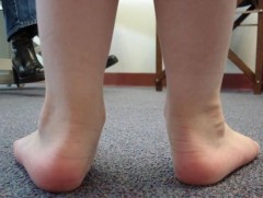 Хүүхдийн хөлийн нум хөгжөөгүй үед хүнд, чанга гишгэх, өсгий хэт гадагшаа, эсвэл дотогшоо хэлбийх н..