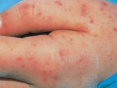 ХӨСҮТ: Менингитийн эрсдэл өндөр улирал эхэлж байна