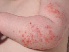 Дархан-Уул аймагт менингококкт өвчний тохиолдол бүртгэгджээ