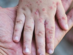 Улаанбурхан халдварлалт өндөртэй ч вакцинаар сэргийлэгдэх боломжтой өвчин