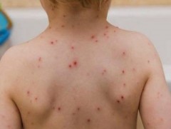 Улсын хэмжээнд менингококкт халдварын батлагдсан 6 тохиолдол бүртгэгдээд байна 