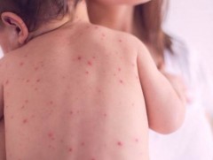 ХӨСҮТ: Улаанбурхан өвчний батлагдсан тохиолдол  10 нэмэгджээ