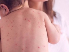 Улаанбурхан өвчин нь халдварлалт өндөртэй ч вакцинаар сэргийлэгдэх боломжтой